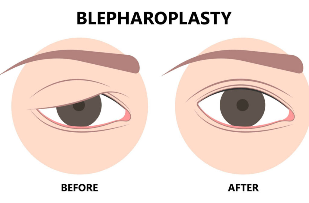An infographic showing the before and after of a blepharoplasty procedure