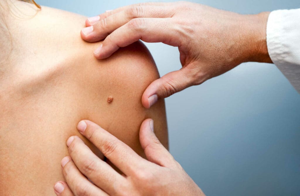 A dermatologist examining a mark on a patient's shoulder to determine if it is skin cancer