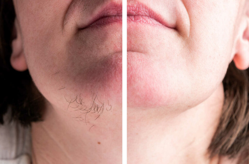 A comparison to show difference in facial hair on the chin before and after a laser hair removal procedure.